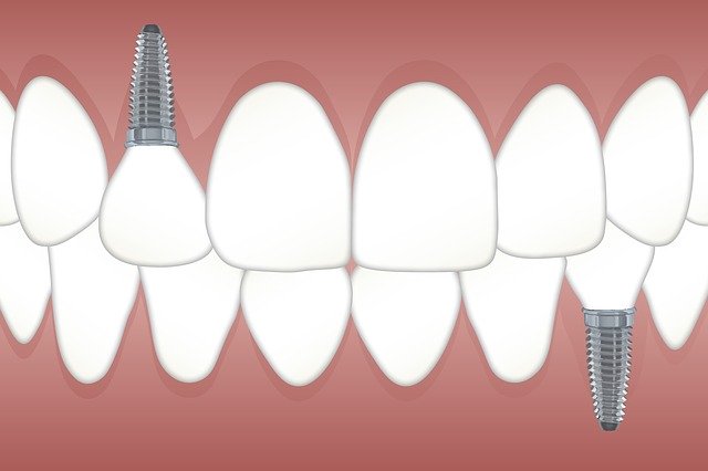 zubní implantát